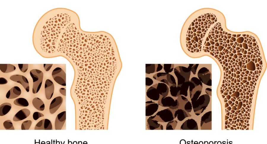 osteoporosis bone